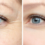 BayviewGeneralMedicine_DysportSkinTightening